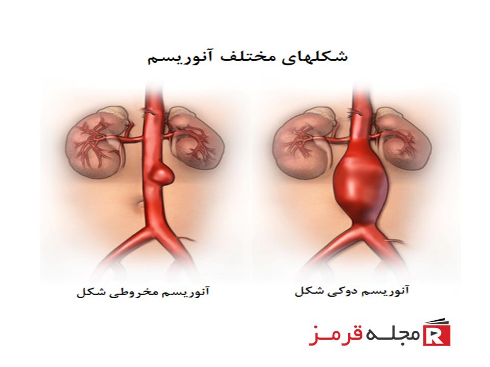 آنوریسم آئورت شکمی