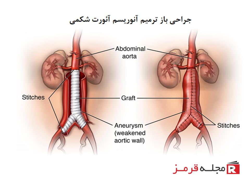 جراحی آنوریسم آئورت شکمی