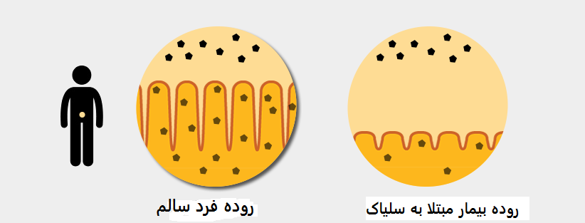 تفاوت روده فرد سالم و بیمار سلیاک