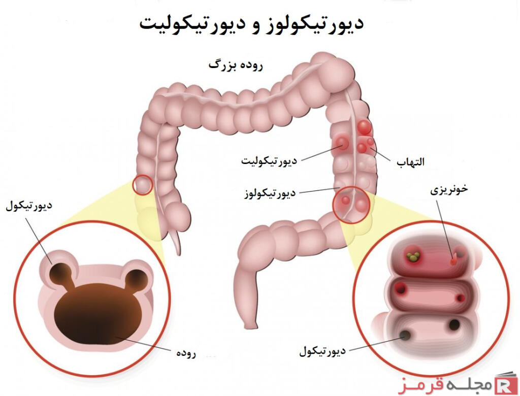 دیورتیکولیت