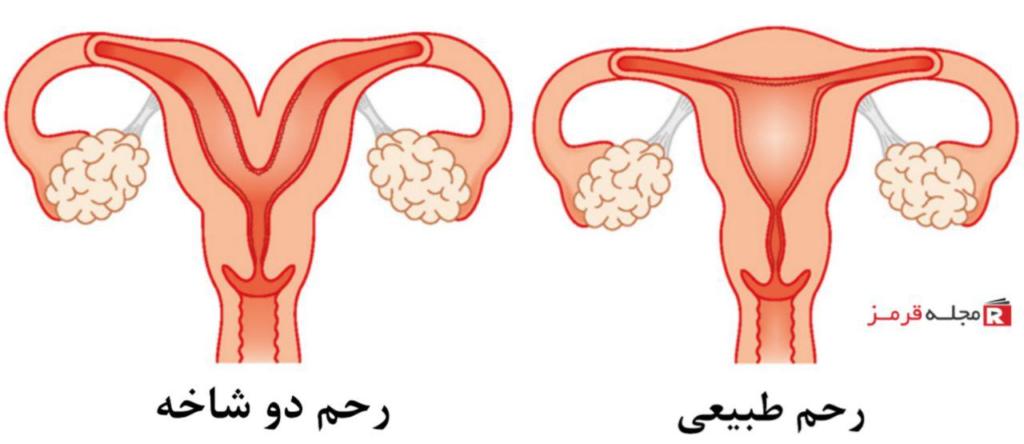 رحم دو شاخه