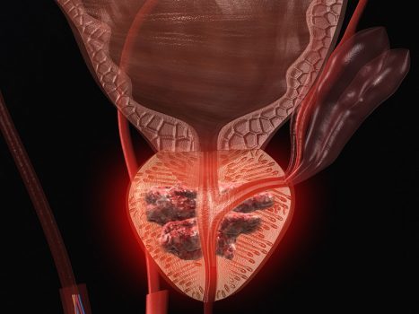نکات کلیدی در مورد سرطان پروستات