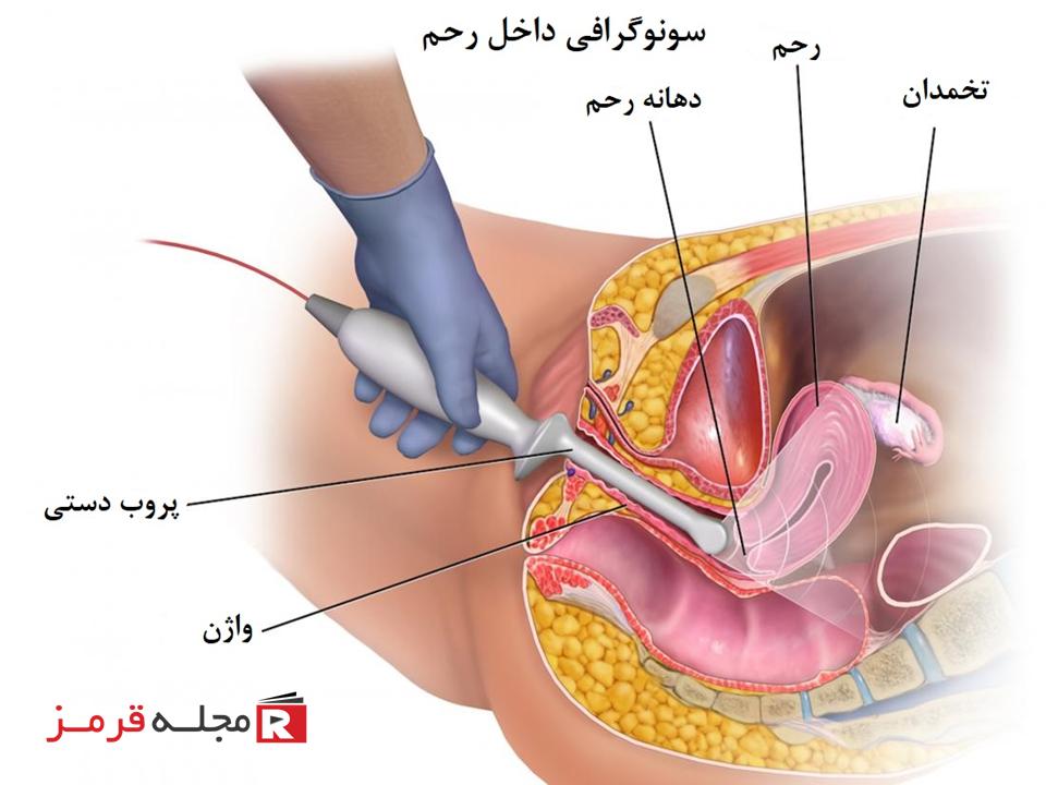 سونوگرافی داخل رحم