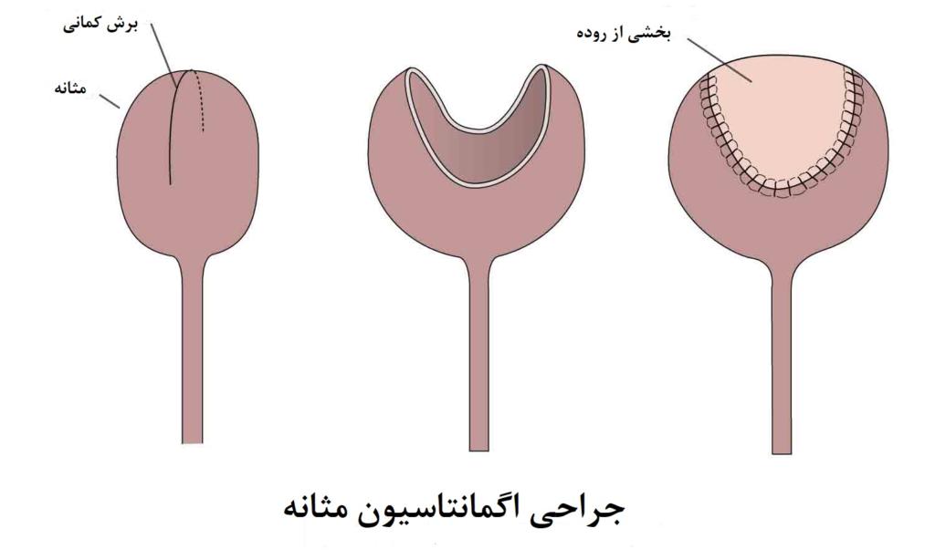 جراحی اگمانتاسیون مثانه داروباکس