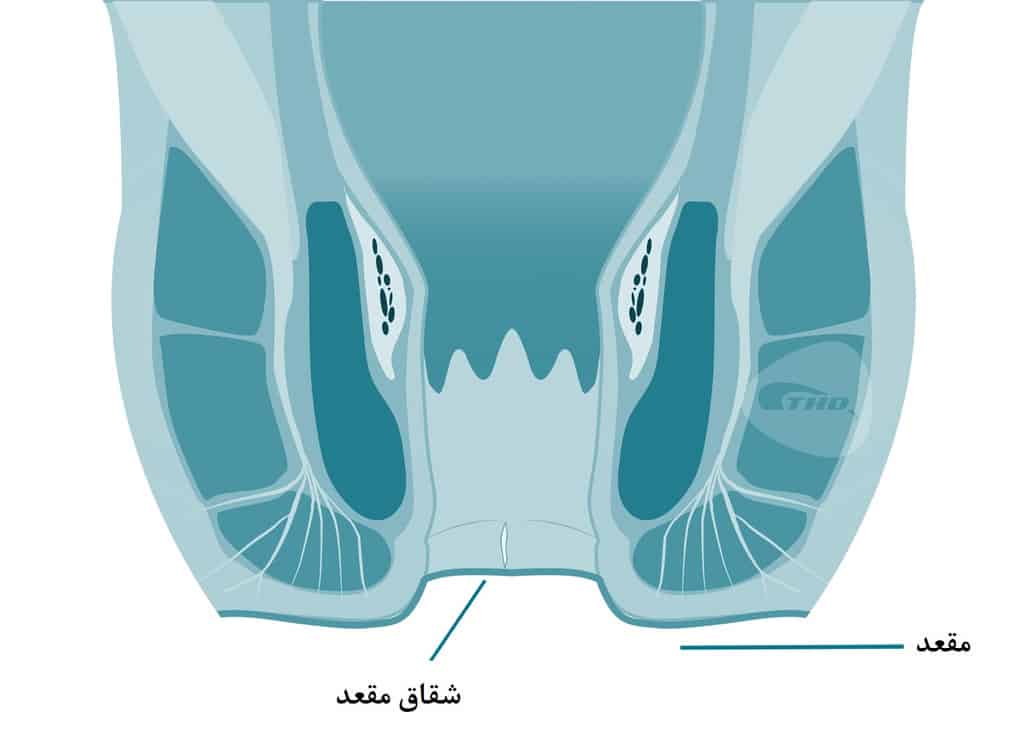 شقاق مقعد، یک بریدگی یا پارگی کوچک در امتداد سوراخ مقعد است.